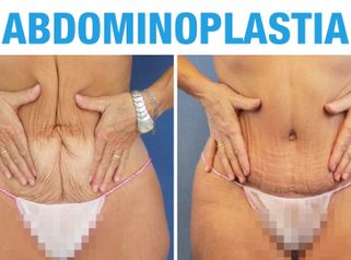 Abdominoplastia después del embarazo – Isabel