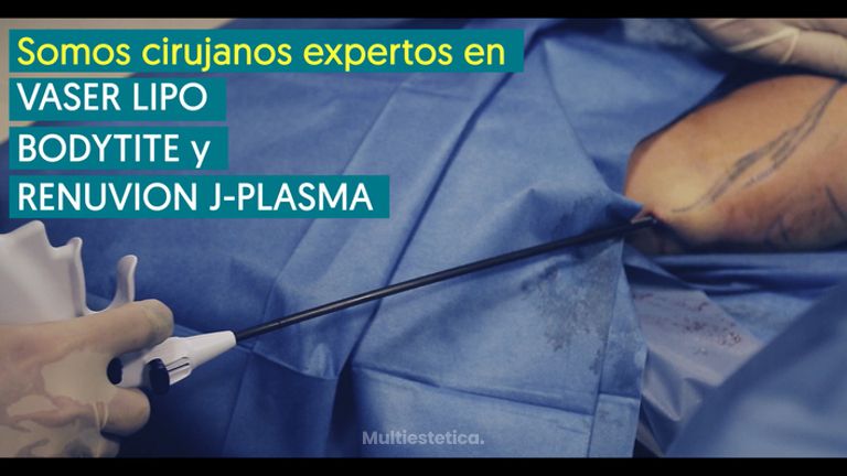 Plasma Renuvion