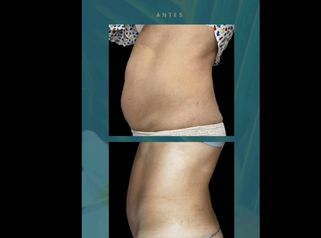 Hakari Clinics - Eliminar grasa loalizada