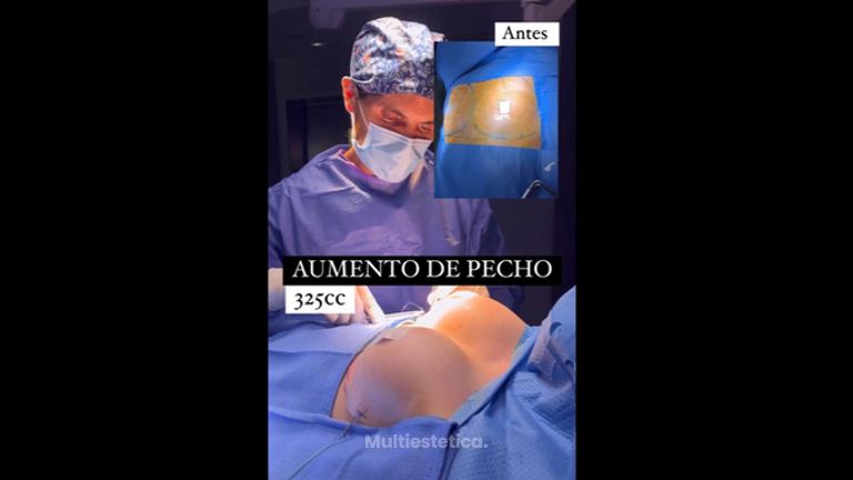 Aumento de pecho - Clínica Dr. Jiménez