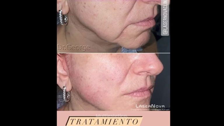 Rejuvenecimiento facial . Clínica Lasernova