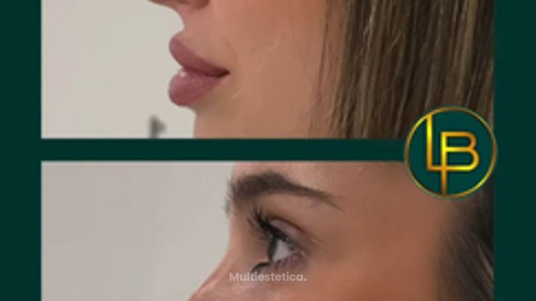 Clínica Dra. Leila Bidaki - Rinomodelación