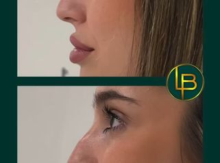 Clínica Dra. Leila Bidaki - Rinomodelación