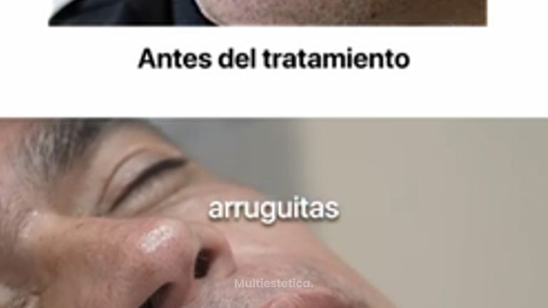 Aumento de labios masculinos