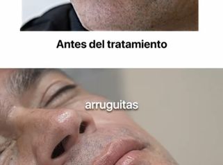 Aumento de labios masculinos