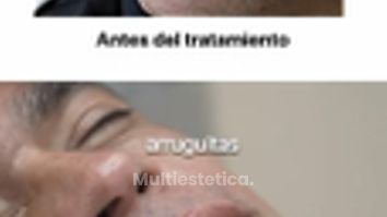 Aumento de labios masculinos