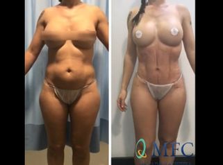 Lipoescultura