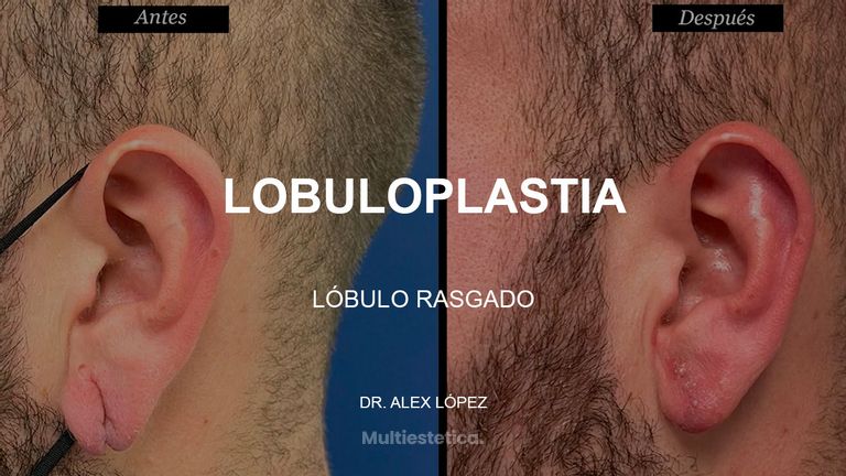 Lobuloplastia -  Clínica Tufet