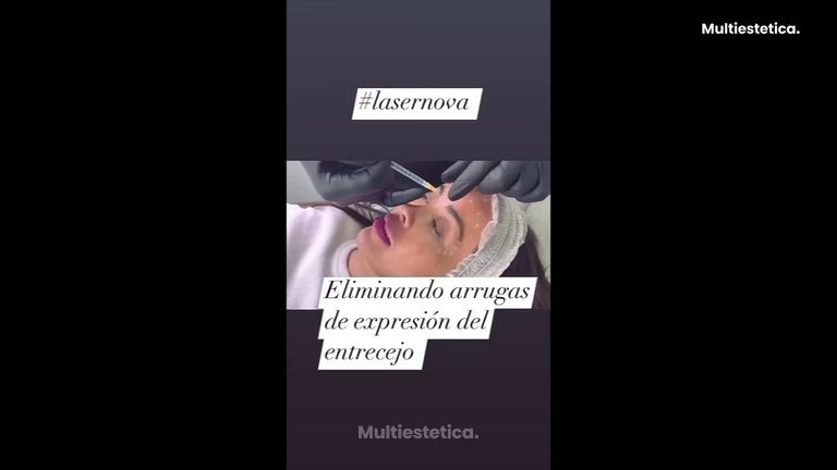 Clínica Lasernova Eliminación de arrugas