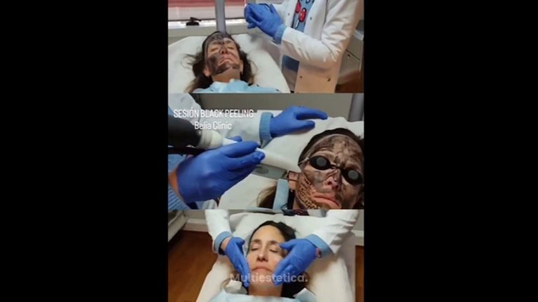Peeling - Belia Clinic
