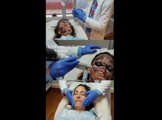 Peeling - Belia Clinic