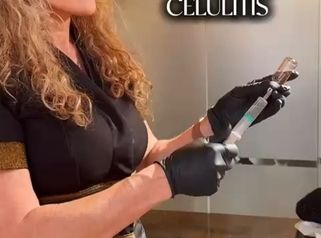 Clínicas Dra. Matas - Celulitis