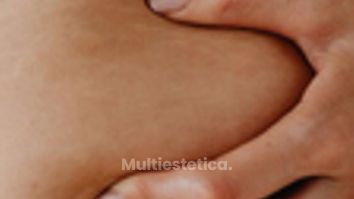 La celulitis no es un fallo.  Es algo normal