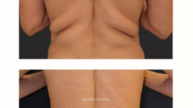 ✨ Contorno corporal - zonas de grasa localizada y resistente - Silueta definida