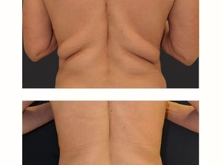 ✨ Contorno corporal - zonas de grasa localizada y resistente - Silueta definida
