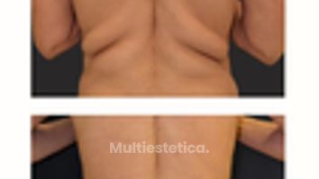 ✨ Contorno corporal - zonas de grasa localizada y resistente - Silueta definida