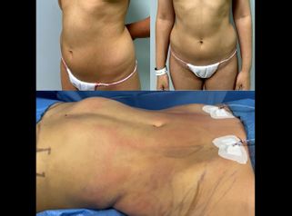 Liposucción - Dr. Quintero