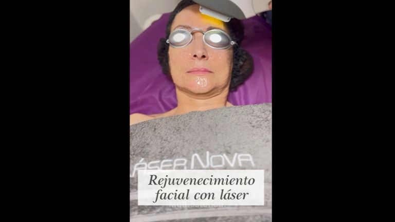 Rejuvenecimiento facial - Clínica Lasernova
