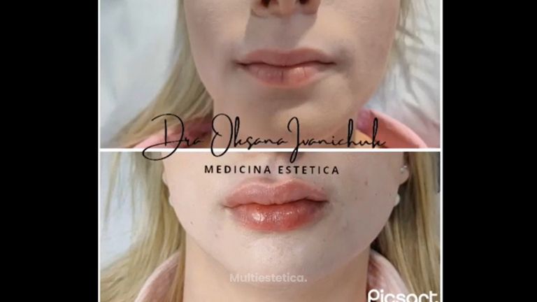 Aumento de labios - Susana & bodyStetic