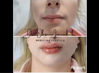 Aumento de labios - Susana & bodyStetic