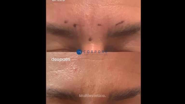 Rellenos faciales - Dr. Juan Enrique Pérez Enríquez