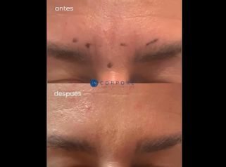 Rellenos faciales - Dr. Juan Enrique Pérez Enríquez