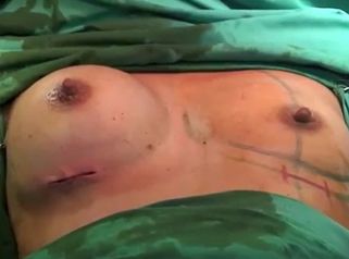 Aumento de pecho  Aumento de mamas  Mamoplastia de aumento - Dr. Guilarte