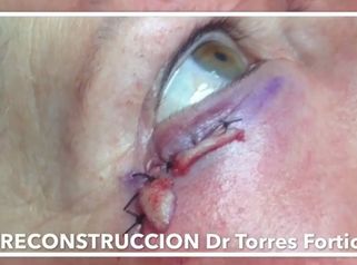 Pon fin a un tumor de piel en el párpado