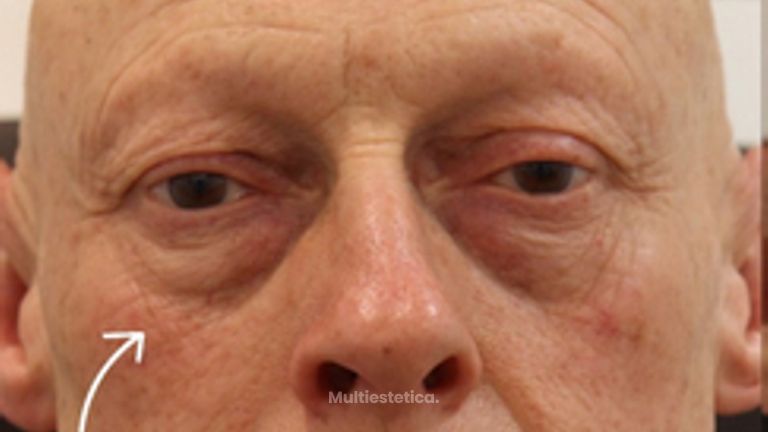 Antes y después de blefaroplastia completa en hombre