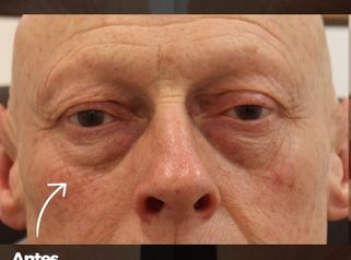 Antes y después de blefaroplastia completa en hombre