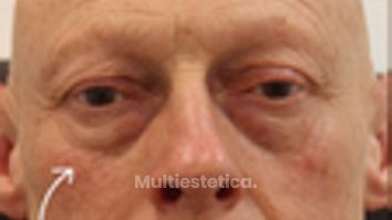 Antes y después de blefaroplastia completa en hombre