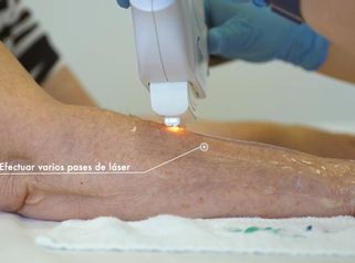 Clínica CIME - Tratamiento Rejuvenecimiento Laser de Manos - Dr. Manuel Rubio