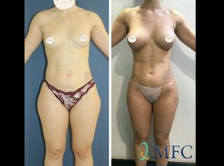 Liposucción 