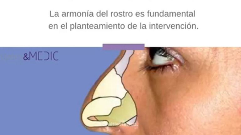 Rinoplastia ultrasonica