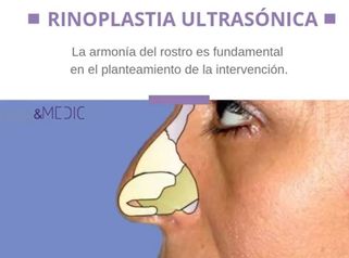 Rinoplastia ultrasonica