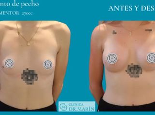 Aumento de pecho - Clínica Dr. Pascual Marín