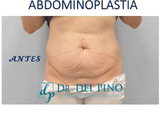 Abdominoplastia - Clínica de estética Dr. del Pino