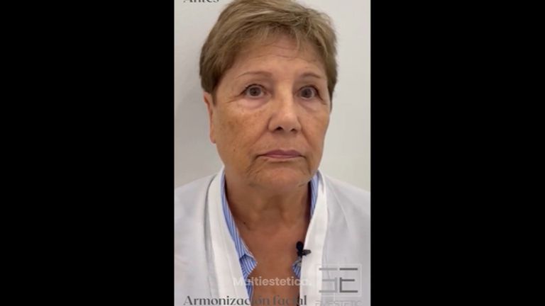 Armonización facial - Eiviestetic