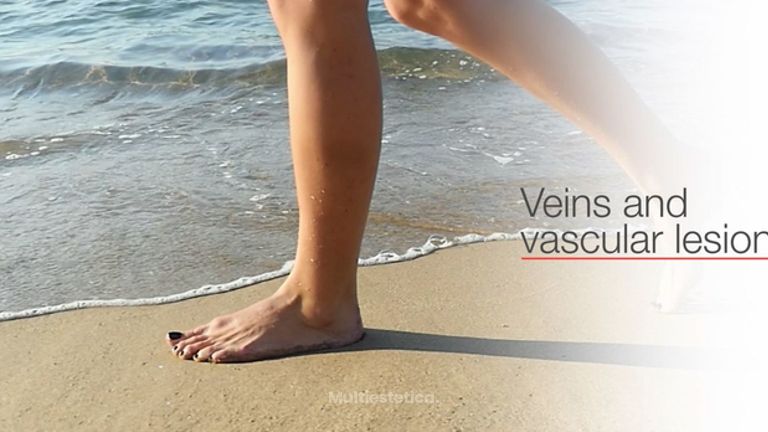 Veins and Vascular lesions