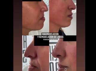 Rinomodelación + Aumento de labios - Dr. Vicente García Vegazo