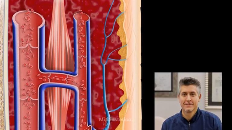 Tratamiento Varices