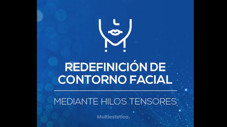 Tratamiento de redefinición de óvalo facial con Hilos Tensores