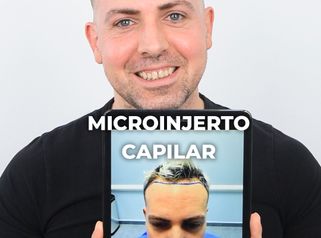 Paciente de Microinjerto Capilar