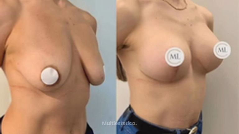 Mastopexia con prótesis - Clínica Dr. Millán Longo y Asociados
