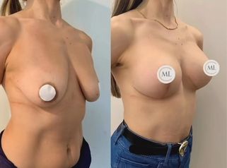 Mastopexia con prótesis - Clínica Dr. Millán Longo y Asociados