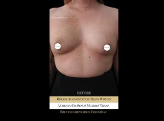 Aumento de pecho mujer trans - Ocean Clinic Madrid