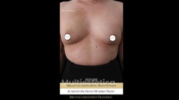Aumento de pecho mujer trans - Ocean Clinic Madrid