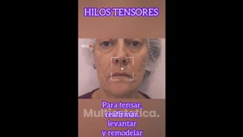 Hilos tensores - Clínica Suárez