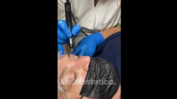 Blefaroplastia sin cirugía - Balneo Estetic Pasbel