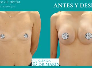 Aumento de pecho - Clínica Dr. Pascual Marín